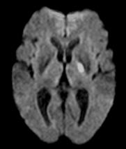 Subcortical Lacunar Stroke (internal capsule on the left)