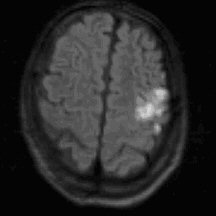 Left fronto-parietal cortical stroke