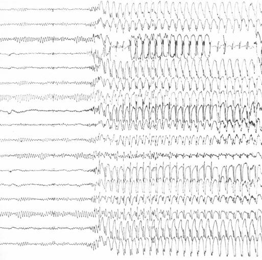 EEG: Patient going into a generalized seizure